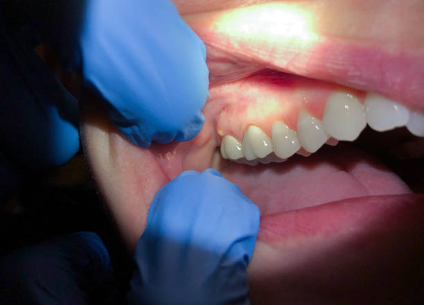 Best Cracked Tooth Emergency Dentist  in Opa Locka, FL